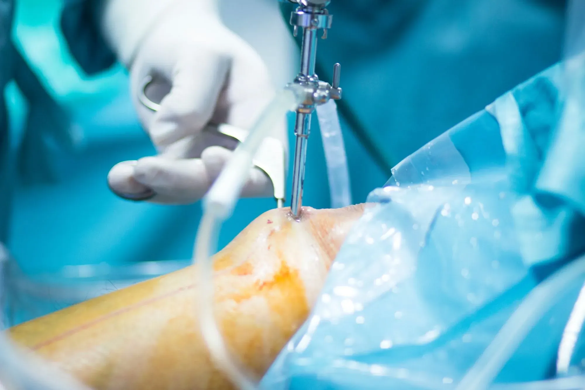Cirurgia Artroscópica
