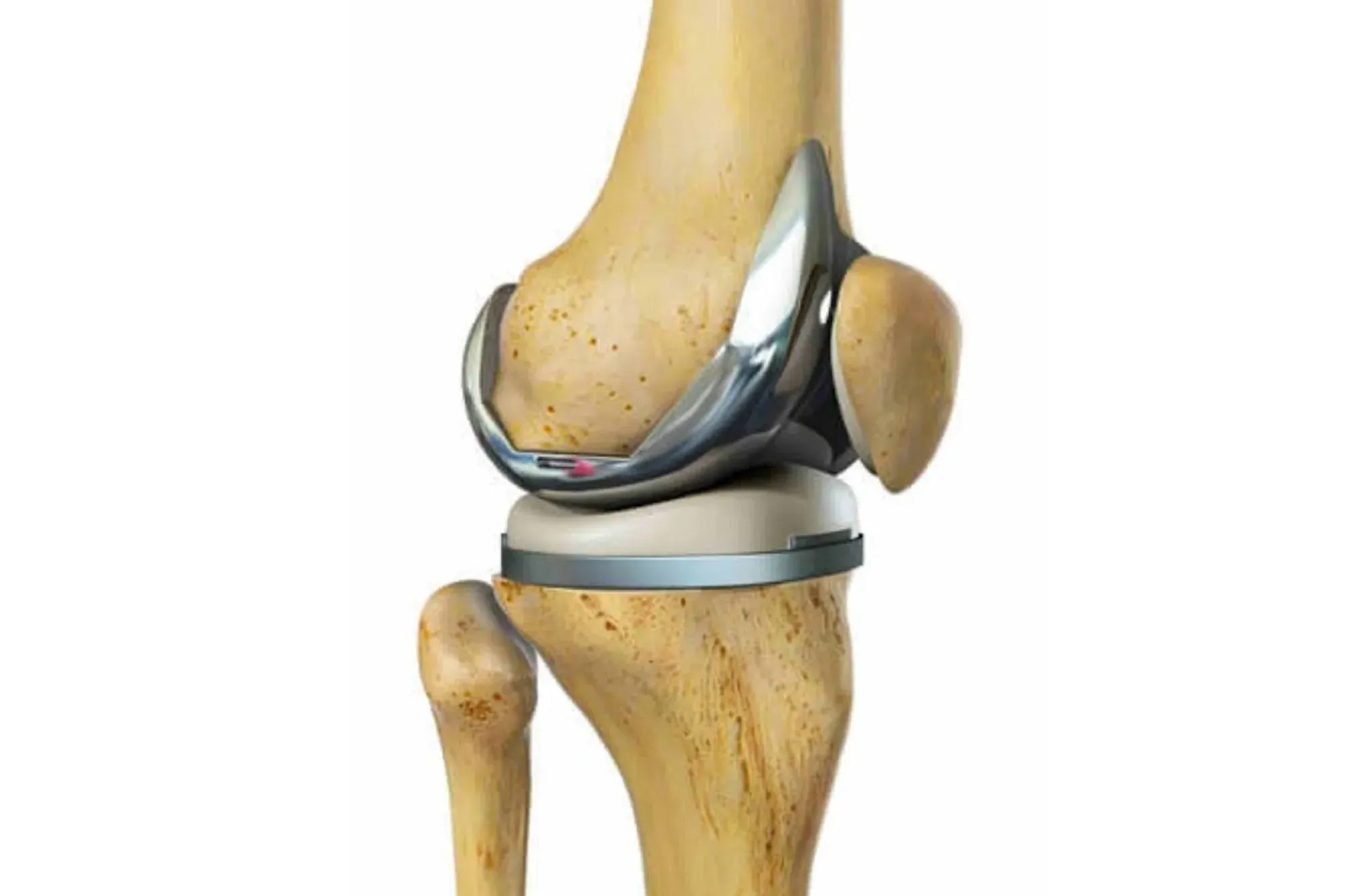 Cirurgia de Prótese